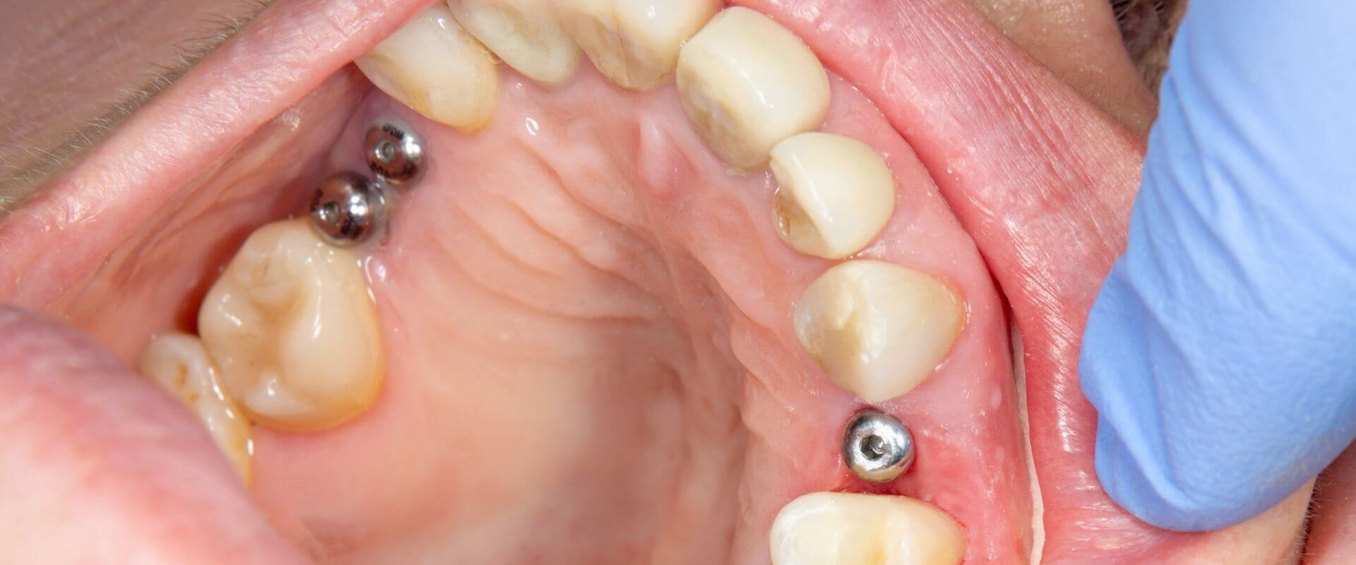 Is it painful to have an implant put in?
