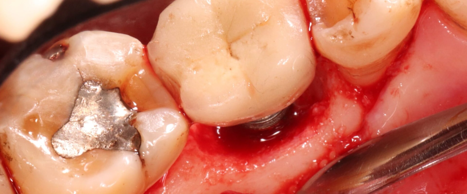 Can a dental implant become infected years later?
