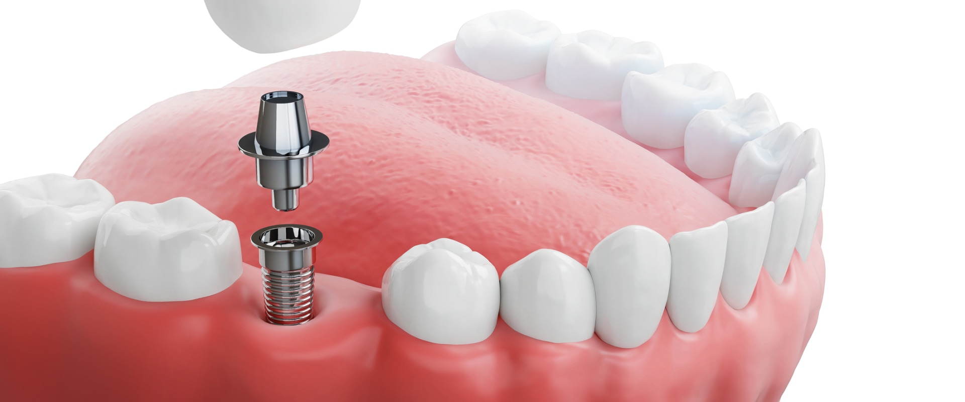 Assessing Bone Density and Gum Health: A Comprehensive Guide to Understanding Dental Implants