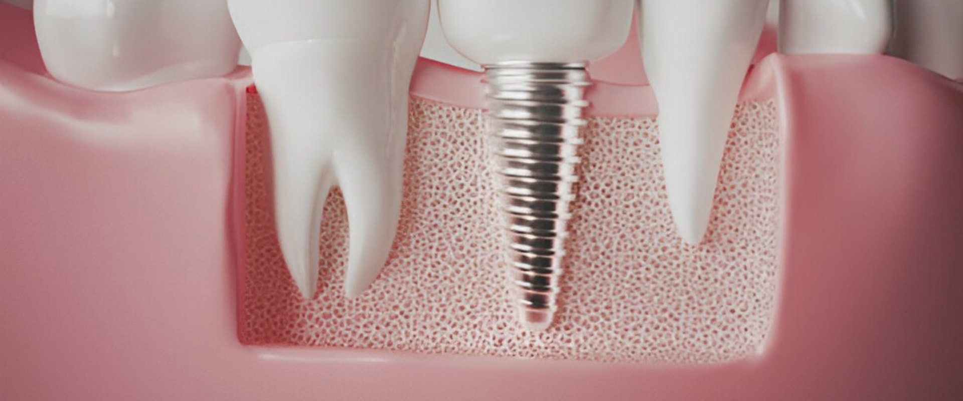 What is the average age to get dental implants?