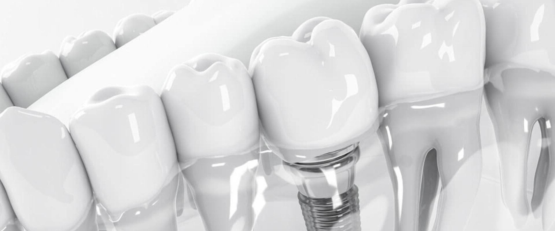 What is the most common complication of dental implants?