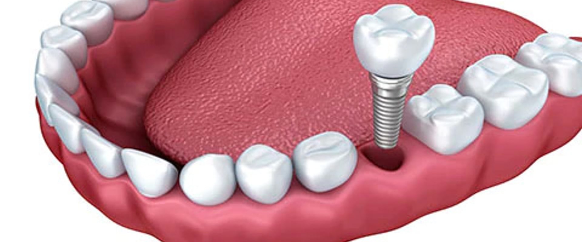 How long does it take for the implant to stop hurting?