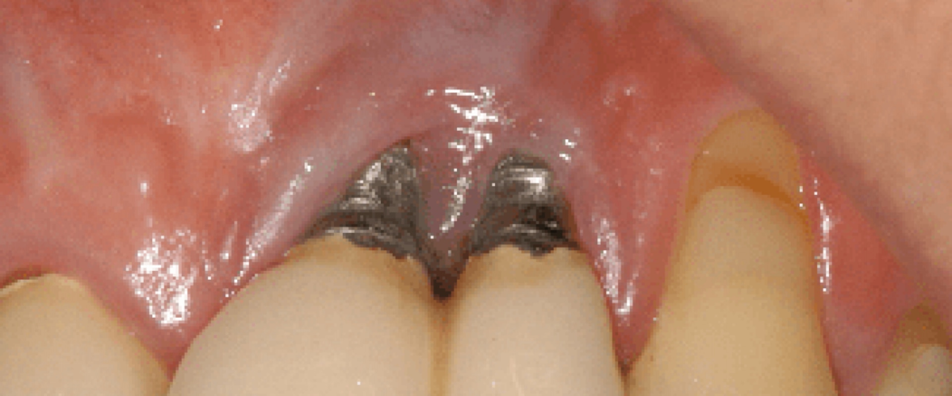 Can a dental implant go bad years later?