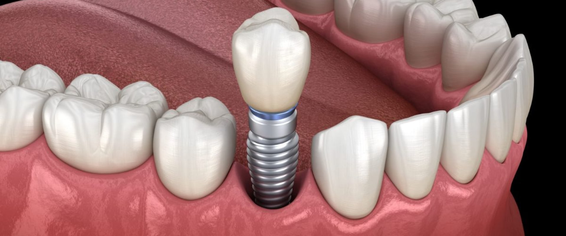 When will i feel better after dental implants?