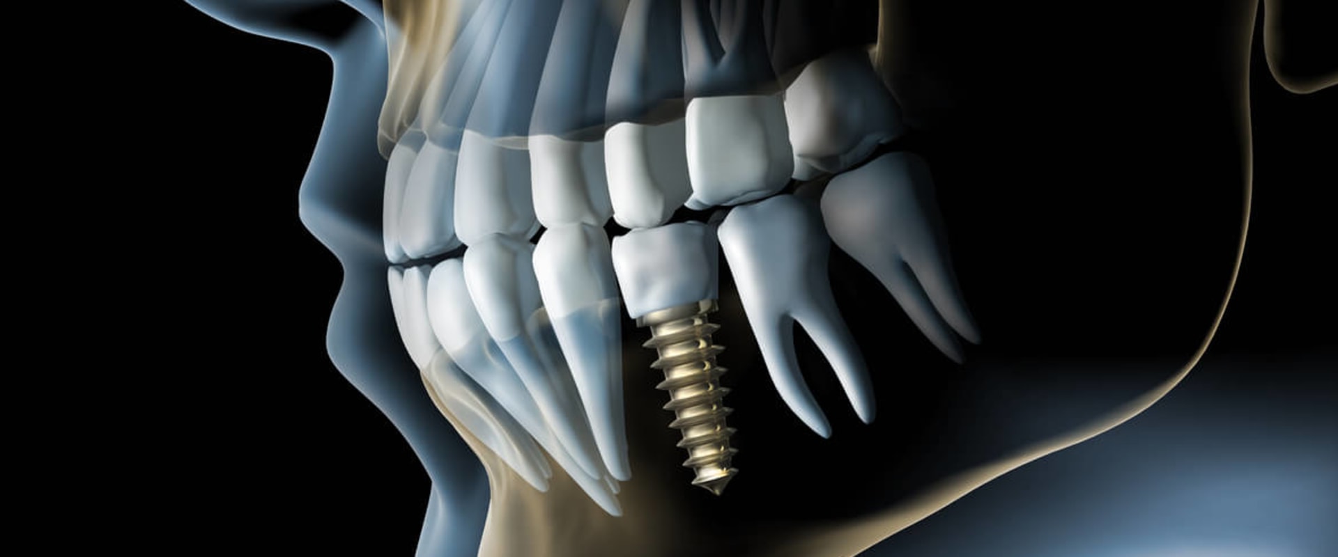 What is the downfall of dental implants?