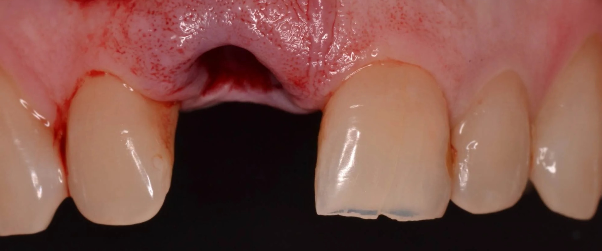 What is the 3/2 rule for dental implants?