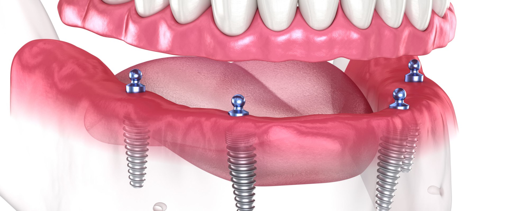 Other Factors to Consider When Getting Full Mouth Dental Implants