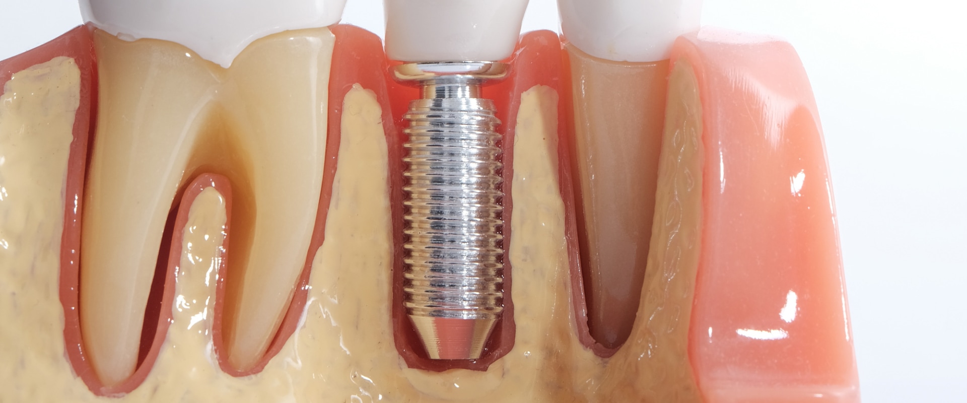 Who shouldn't get a dental implant?