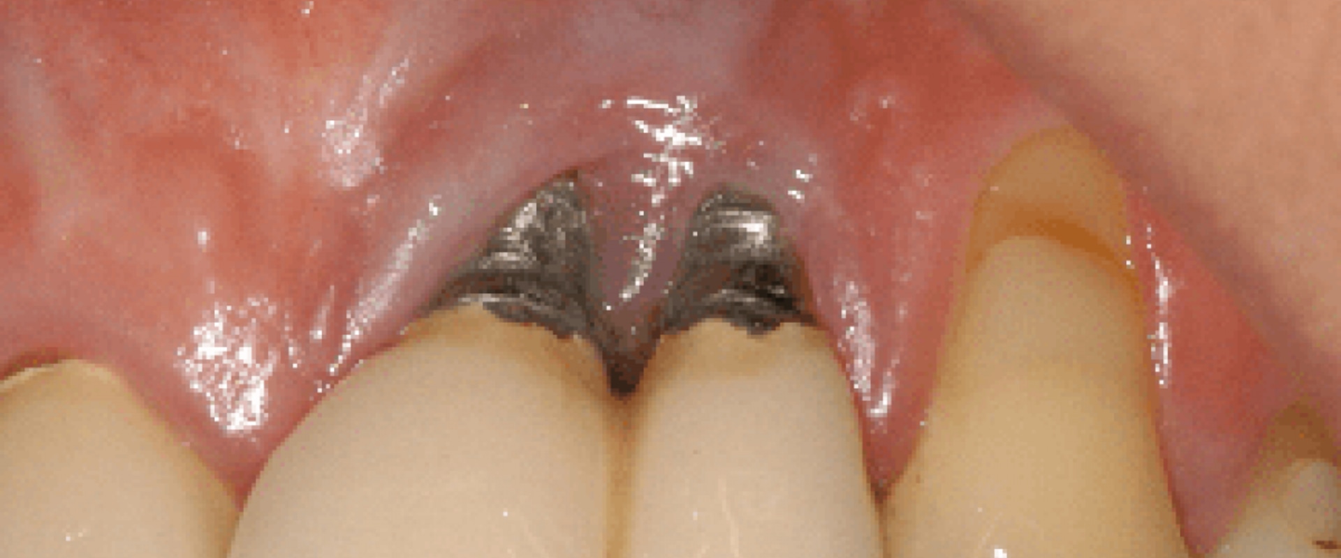 Can a dental implant cause problems years later?