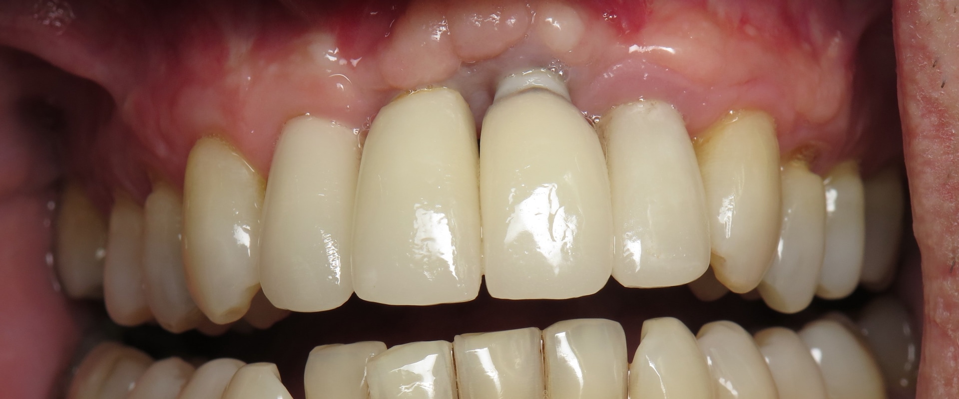 When are dental implants not a good idea?
