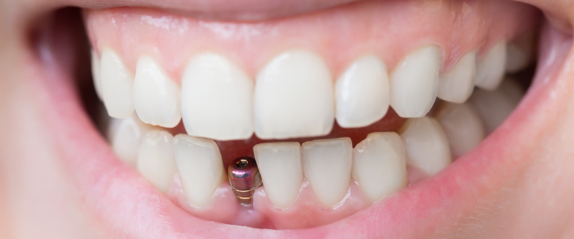 At what stage do dental implants fail?