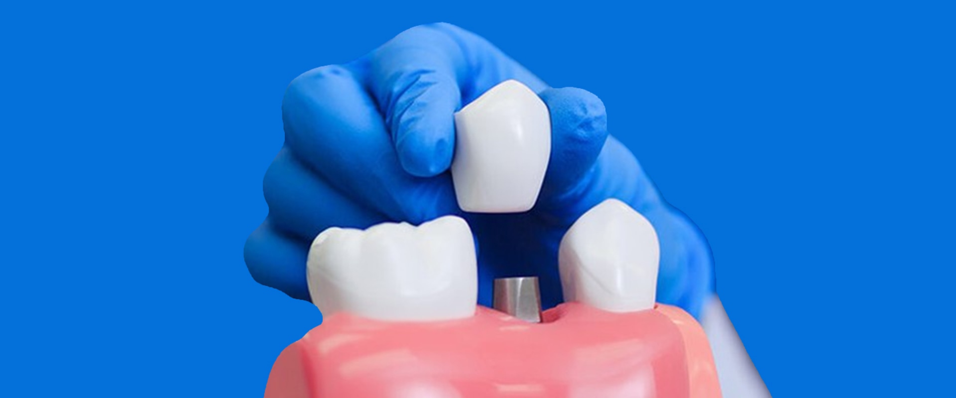 Do dental implants feel strange at first?