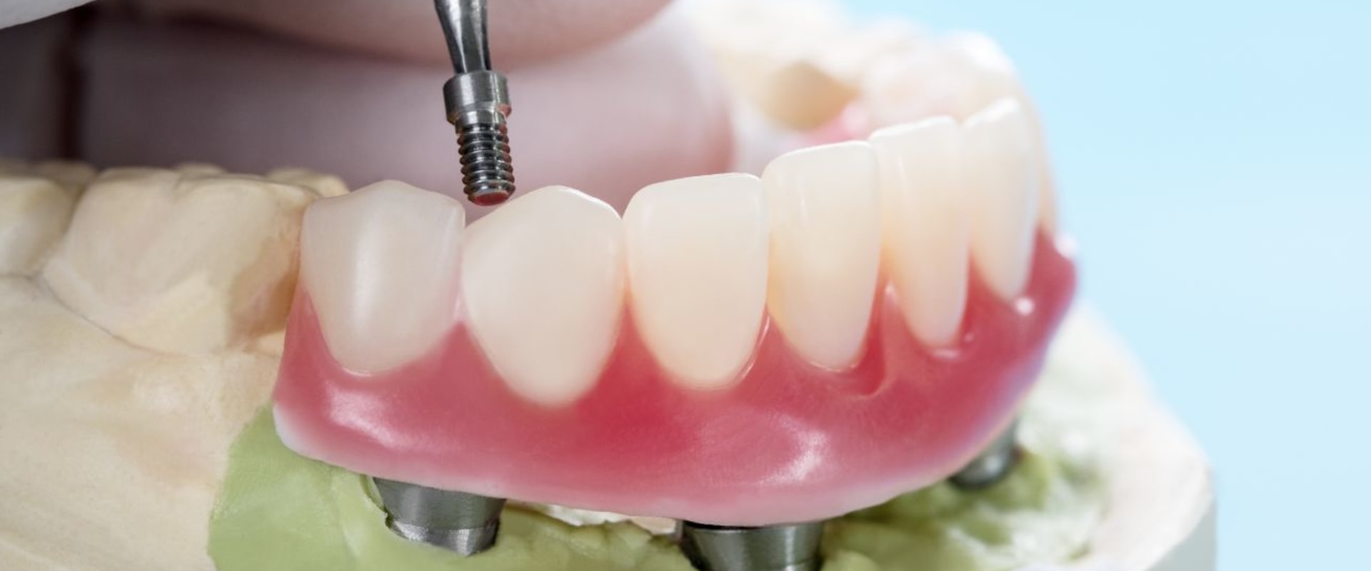 What is the biggest reason implants fail?