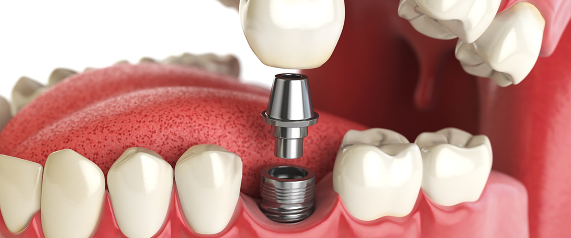 Is it worth it to get a dental implant?