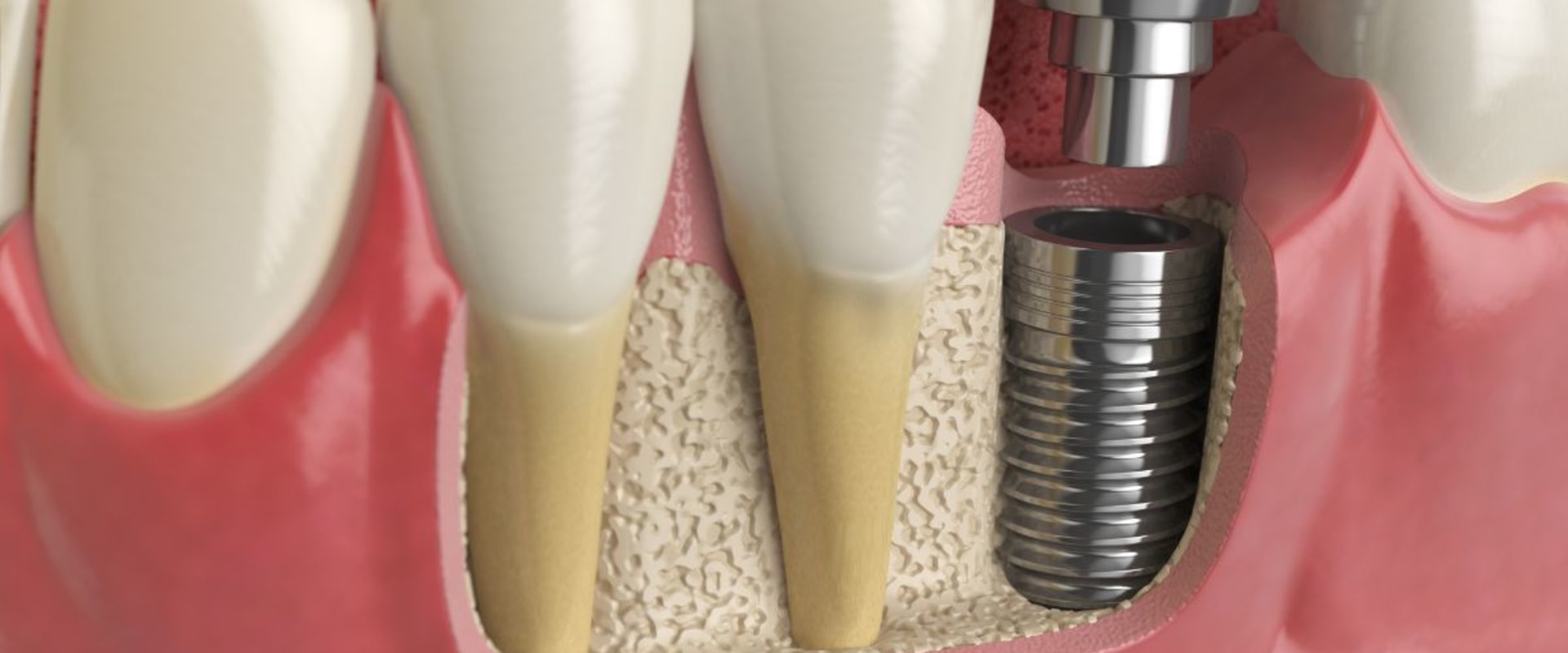 How painful is implant insertion?