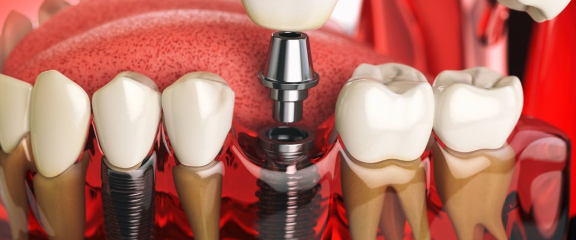 What is the best painkiller for dental implants?