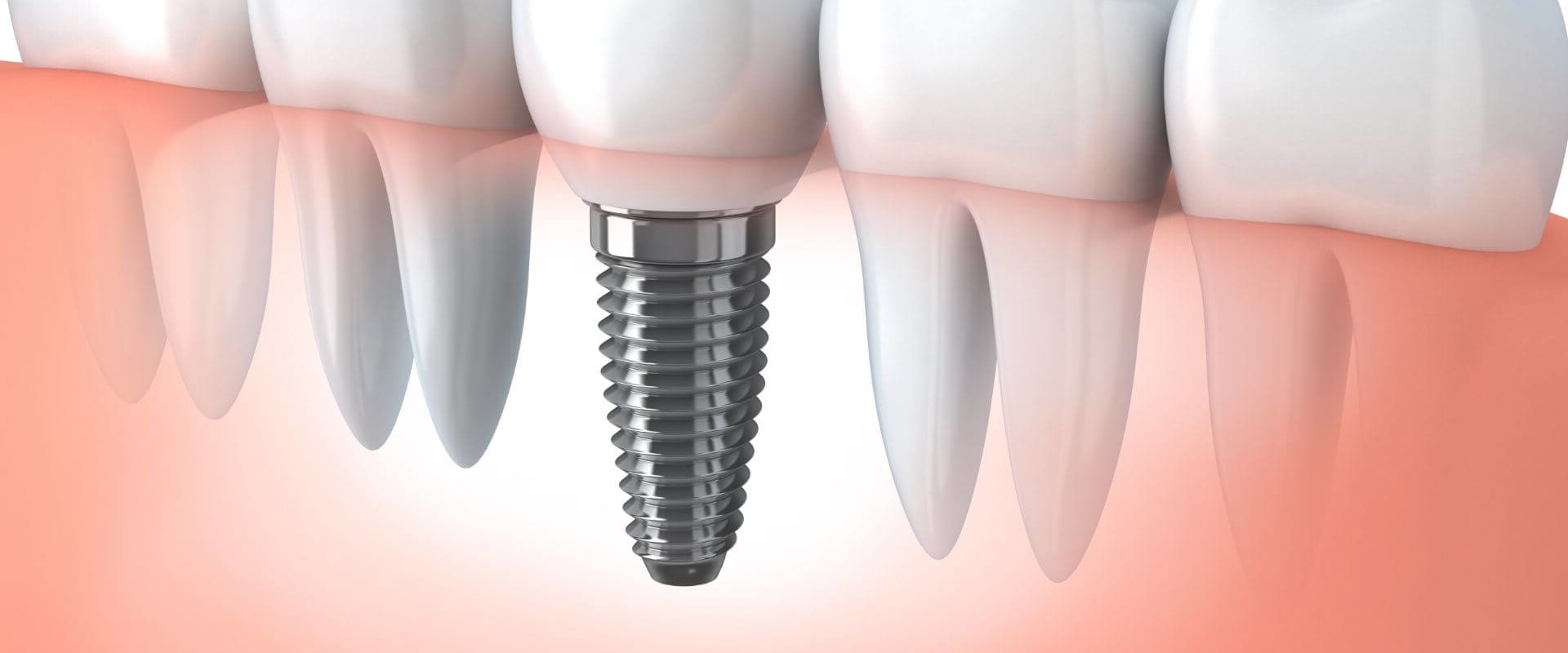 How long is the pain after a dental implant?