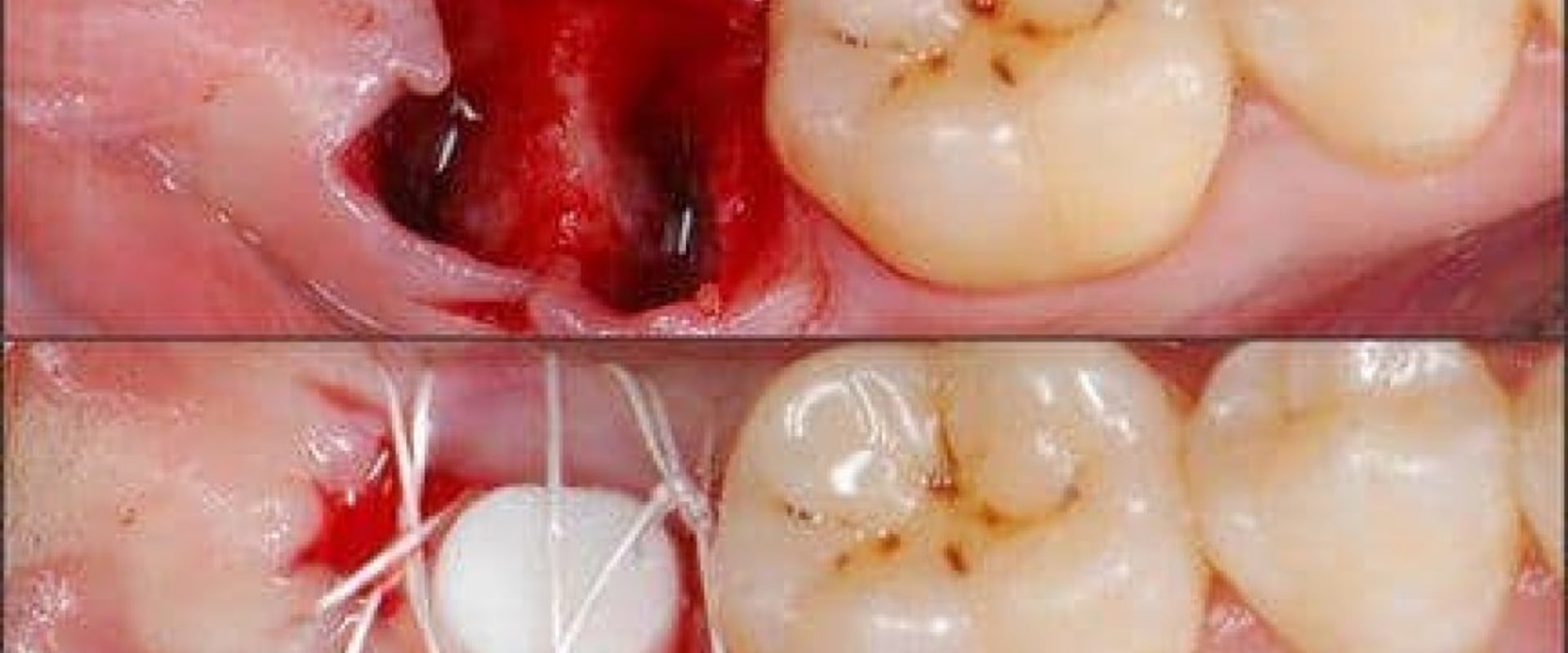 How long does it take for a dental implant to stop hurting?