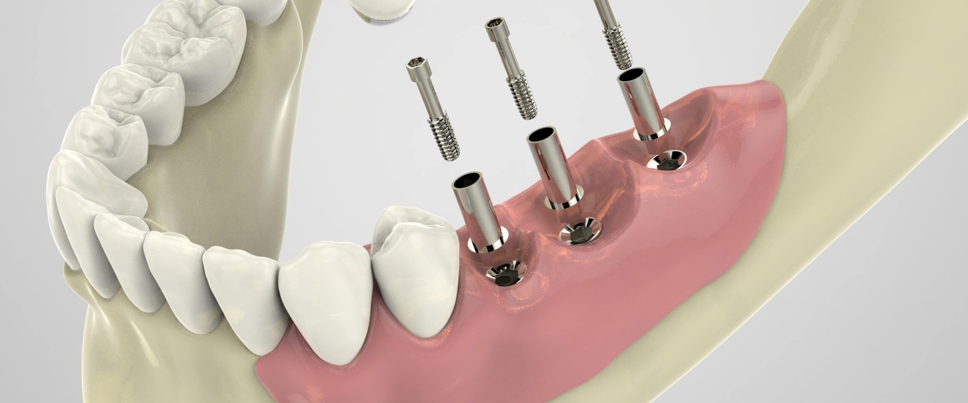 Steps Involved in Full Mouth Implant Placement