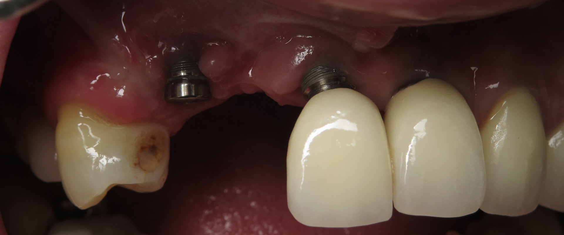 What is the failure rate of dental implants?