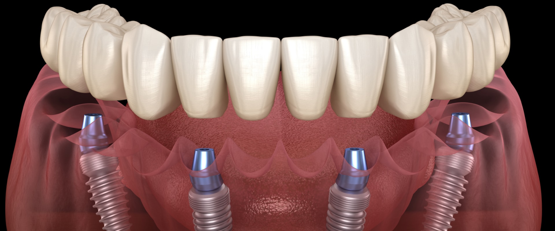 Requirements for Full Mouth Implants: A Comprehensive Guide
