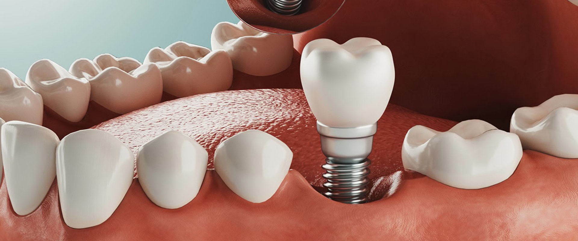 How long do implants take to stop hurting?
