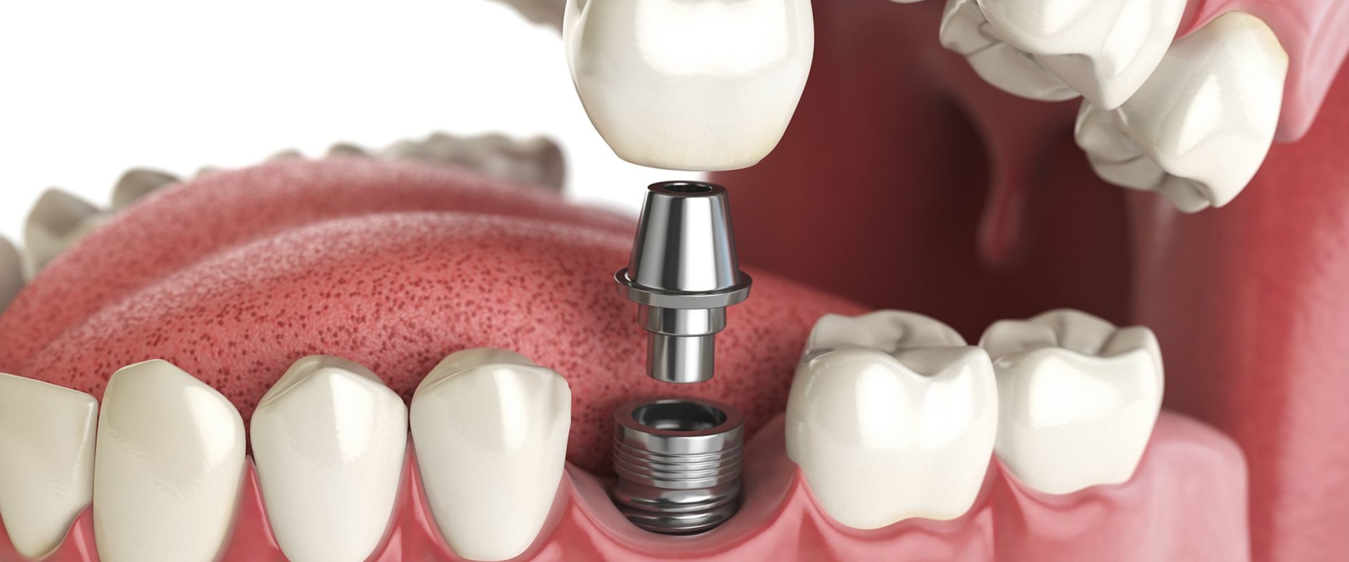 Is dental implant more painful than extraction?