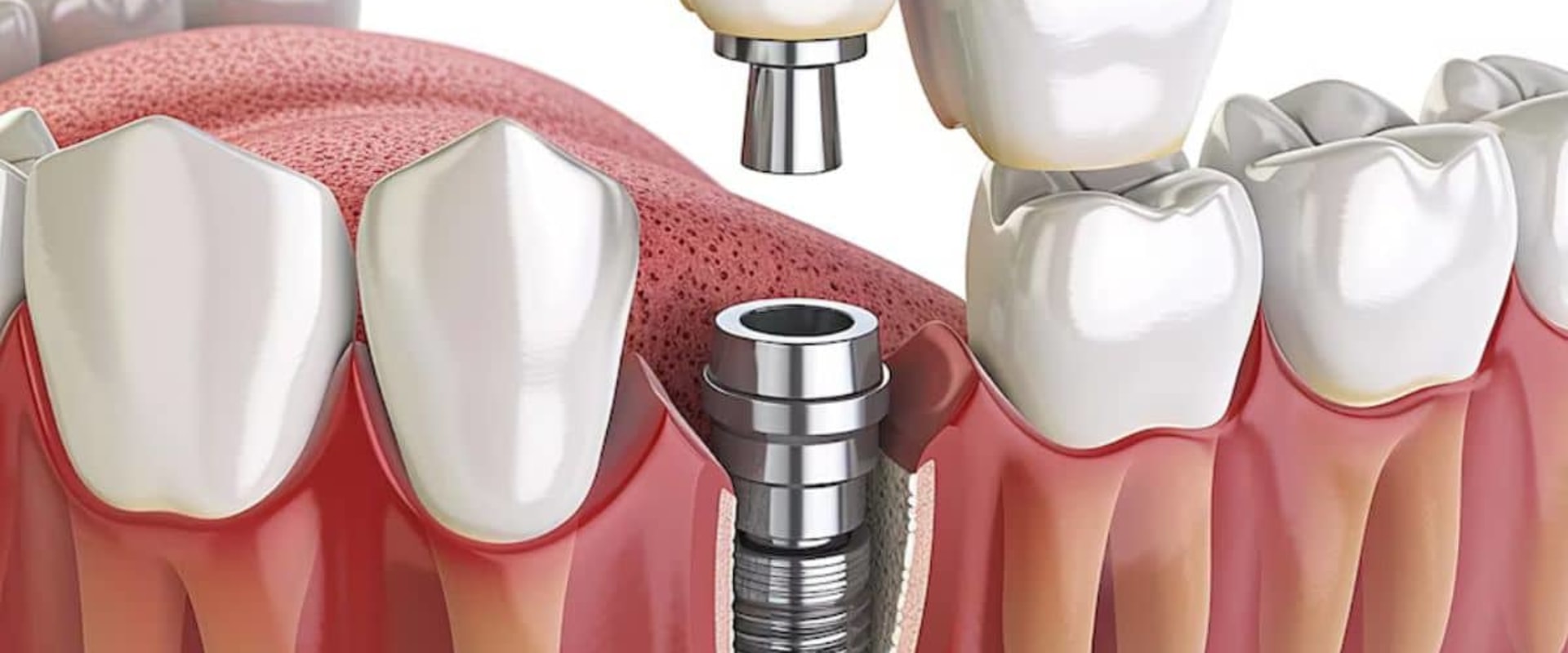 Understanding Follow-Up Care for Dental Implants