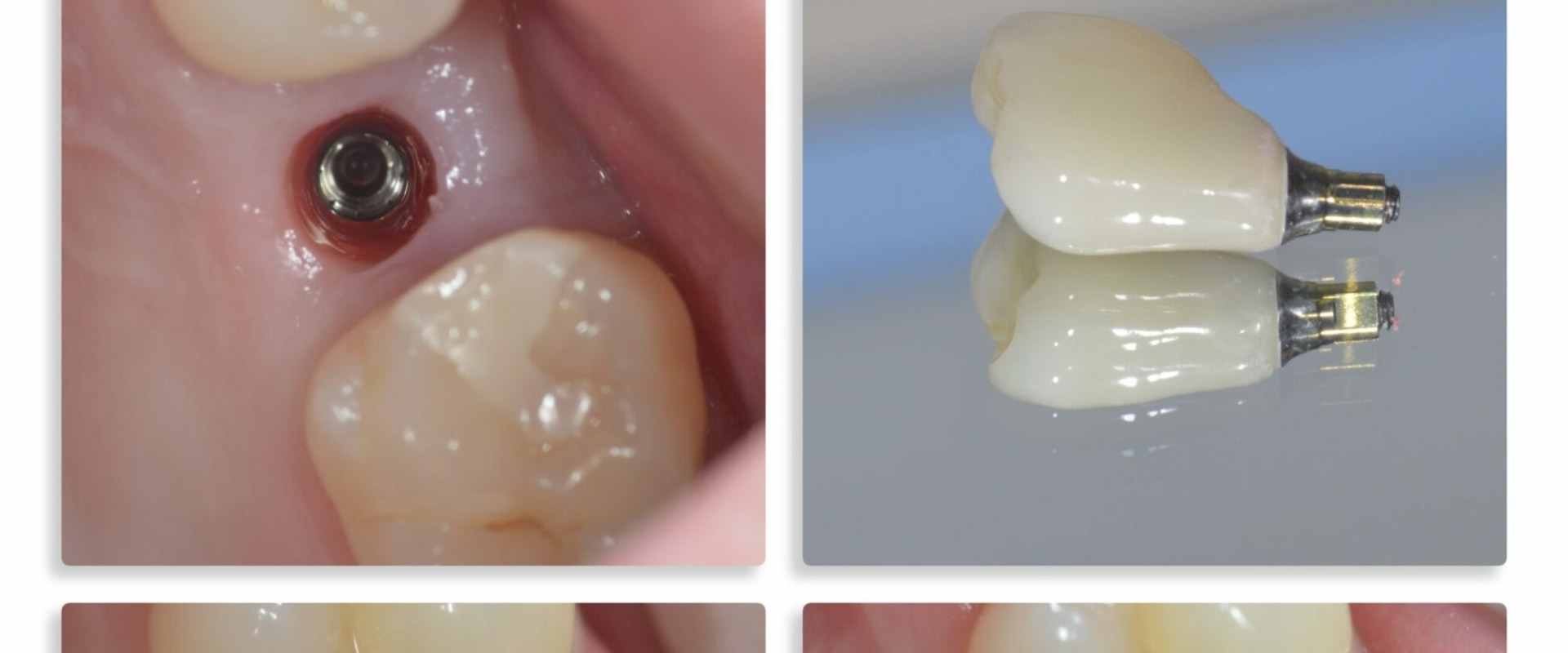 What does the first stage of a dental implant look like?