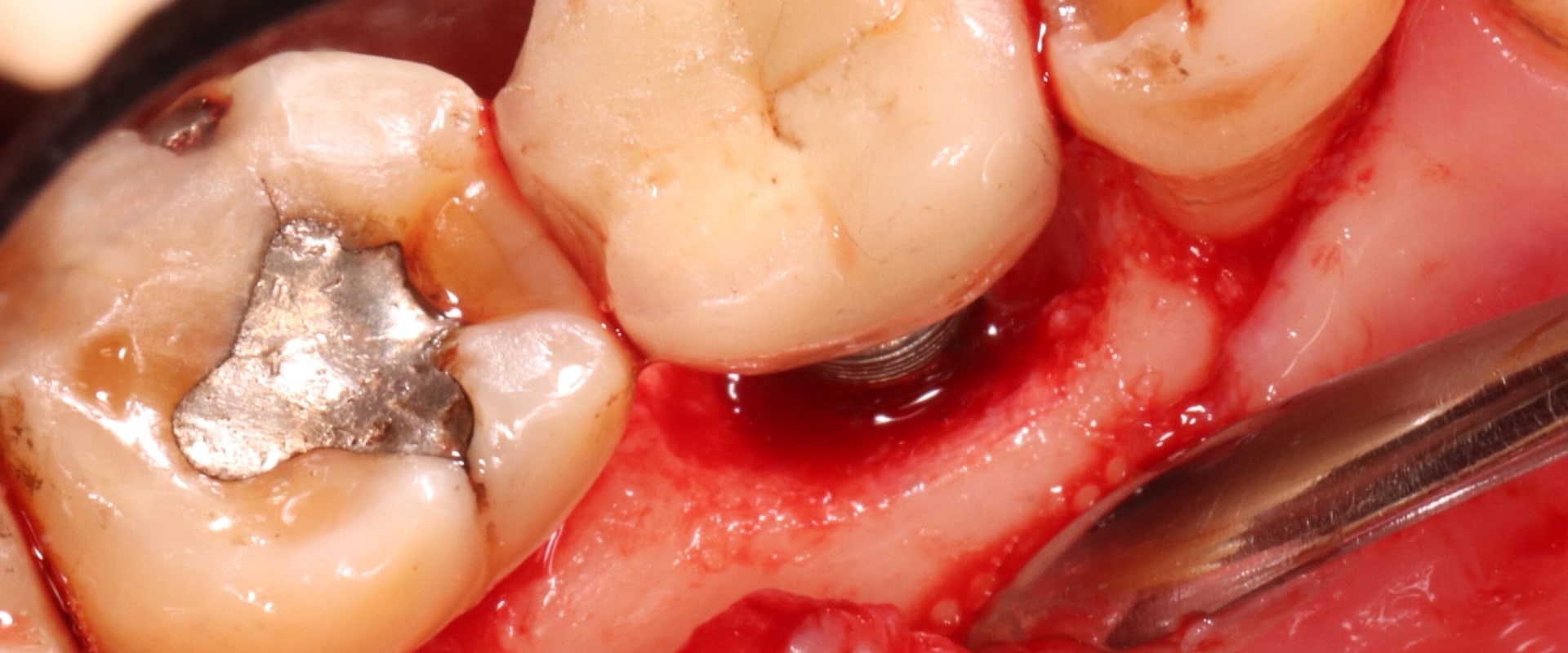 What are the bad experiences with dental implants?