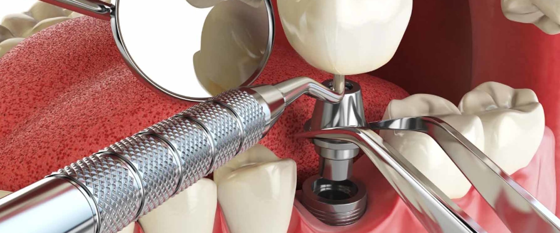 What is the best age to get dental implants?