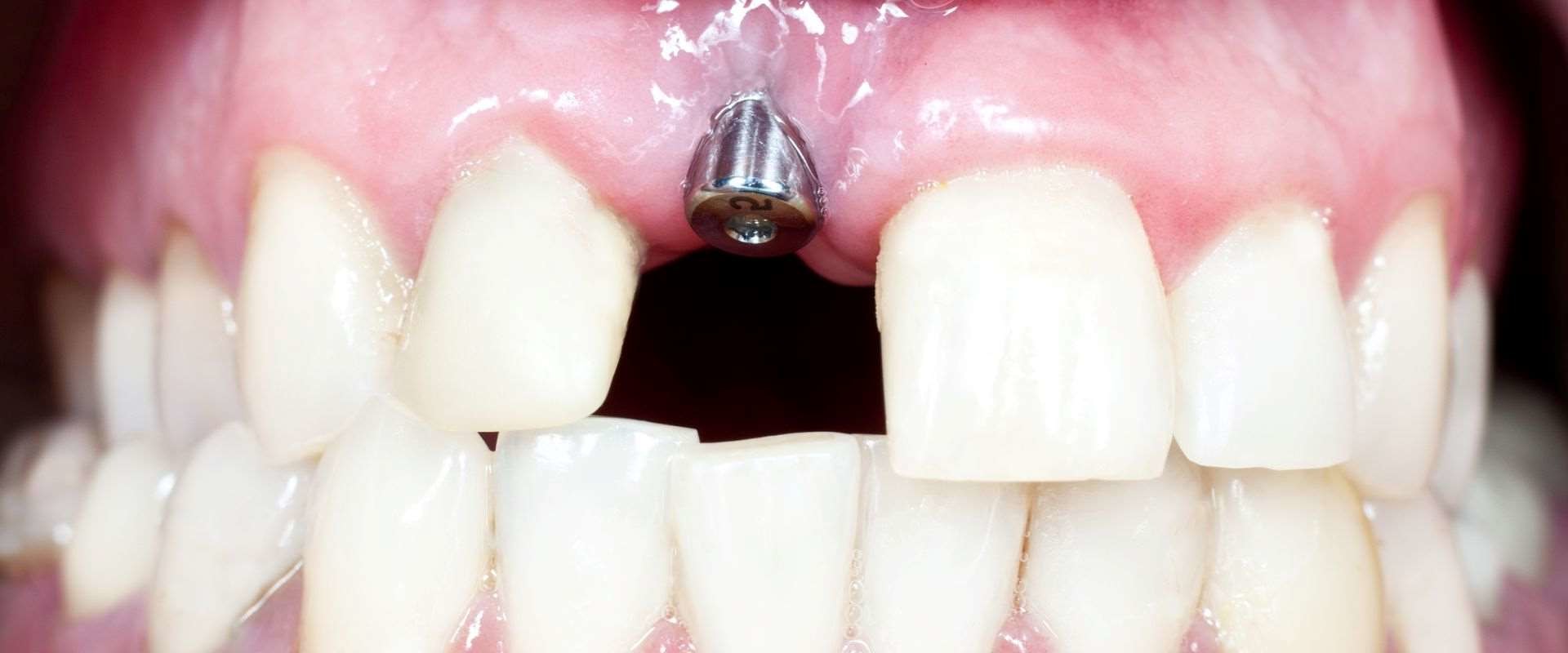 What is the most common site for implant failure?