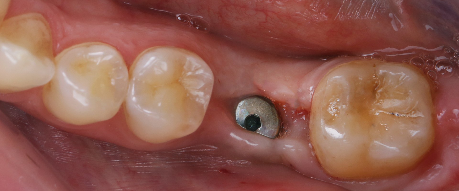 Understanding the Recovery Process and Timeline for Dental Implants