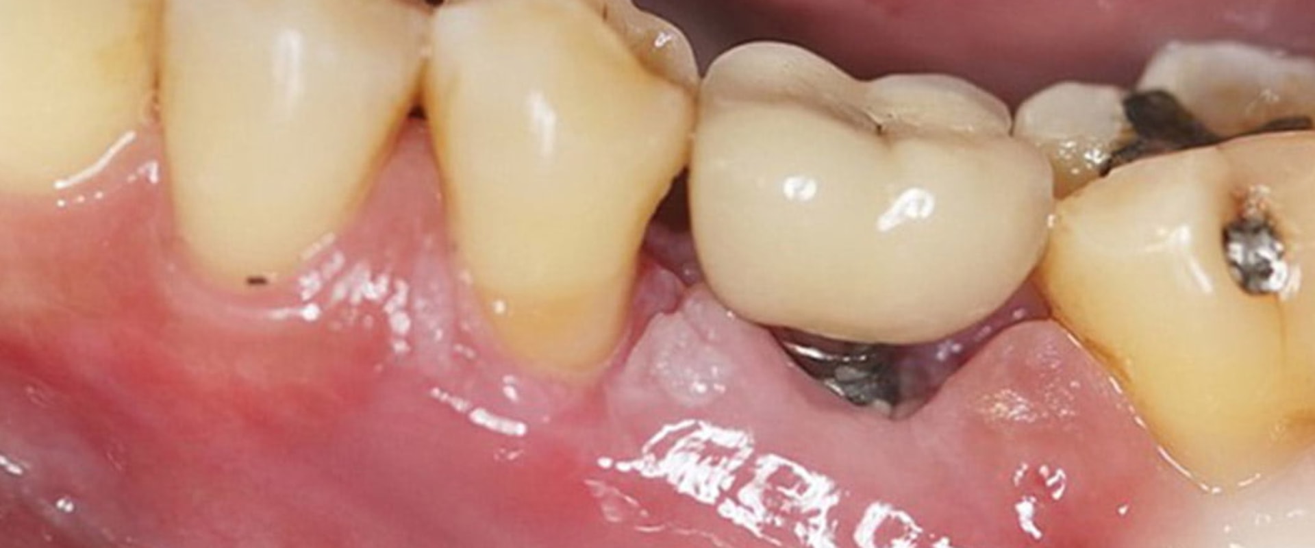 What is the downside of having teeth implants?
