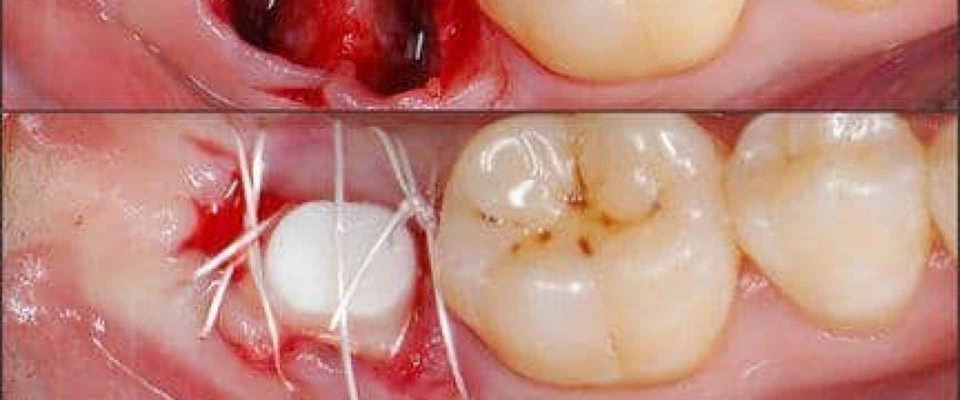 What is the pain level of a dental implant?