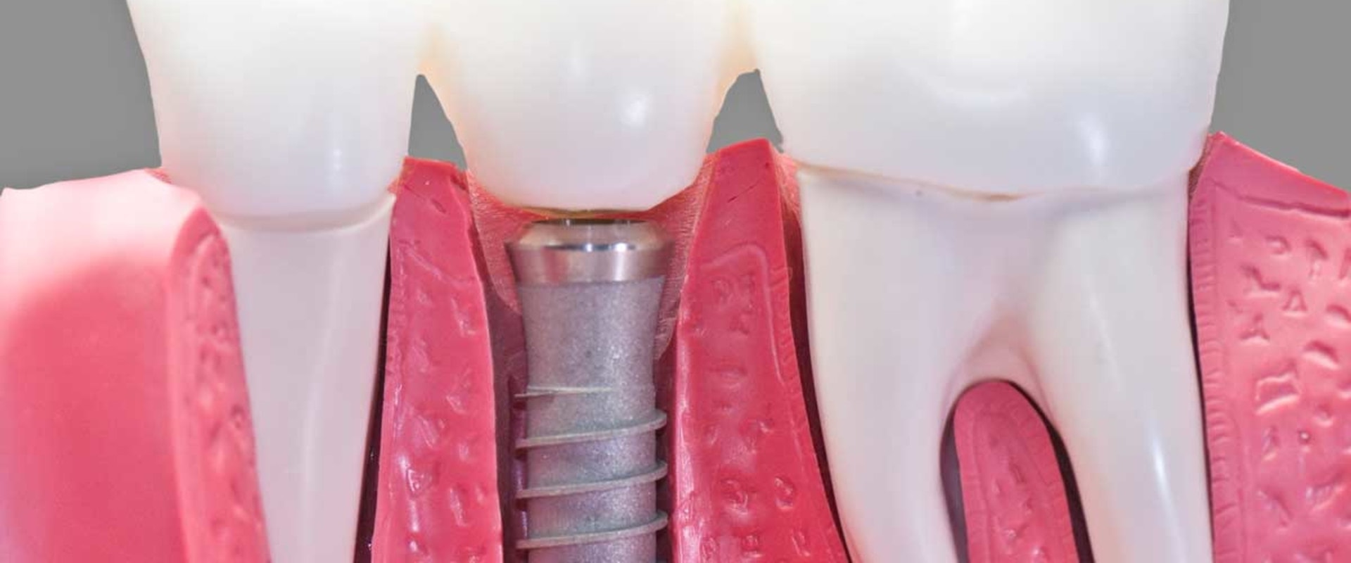 What percent of dental implants are rejected?