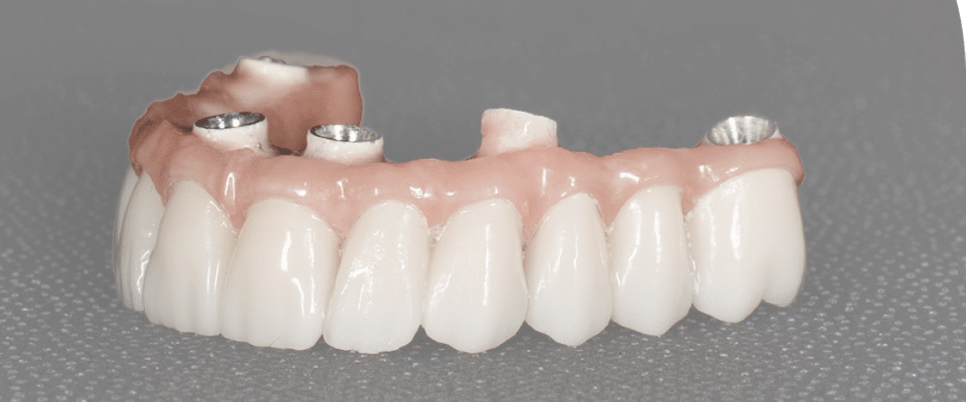 How can a dentist tell if an implant is failing?