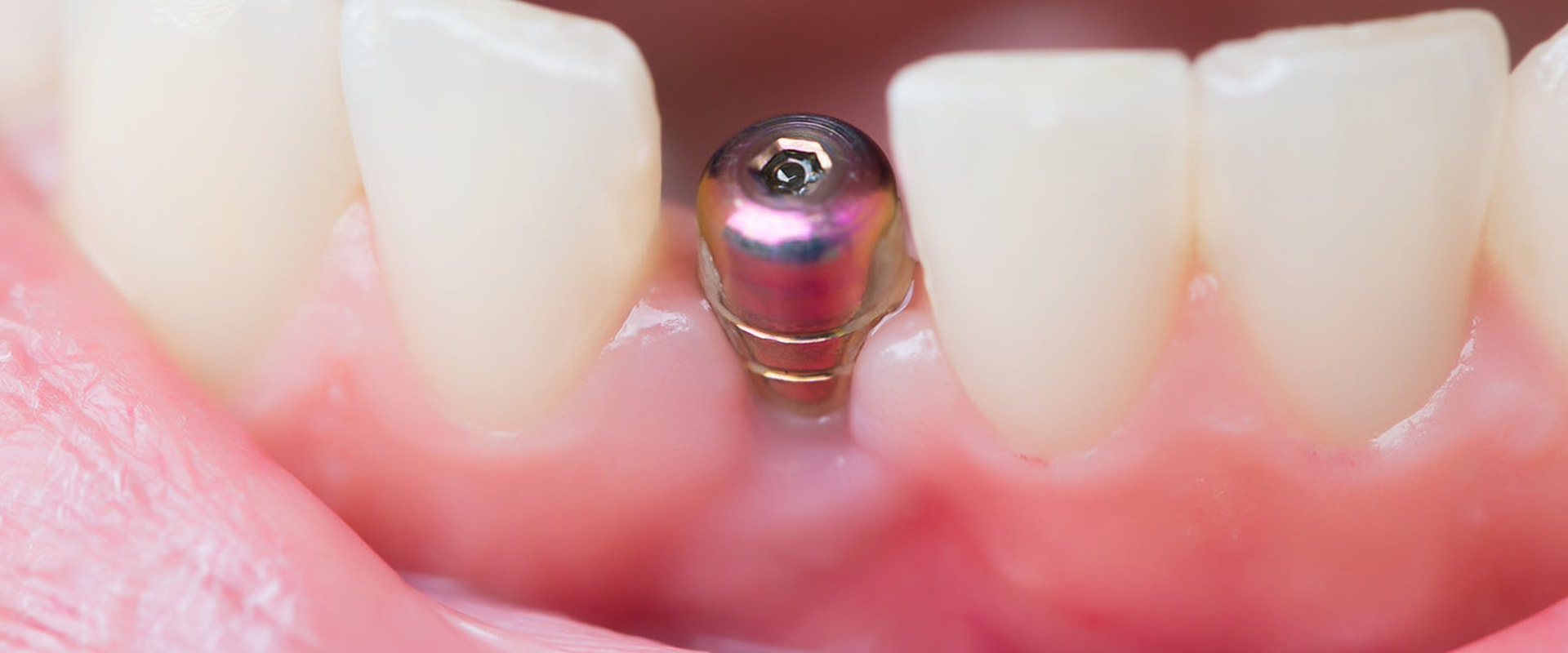 How long does it take to put in the screw for a dental implant?