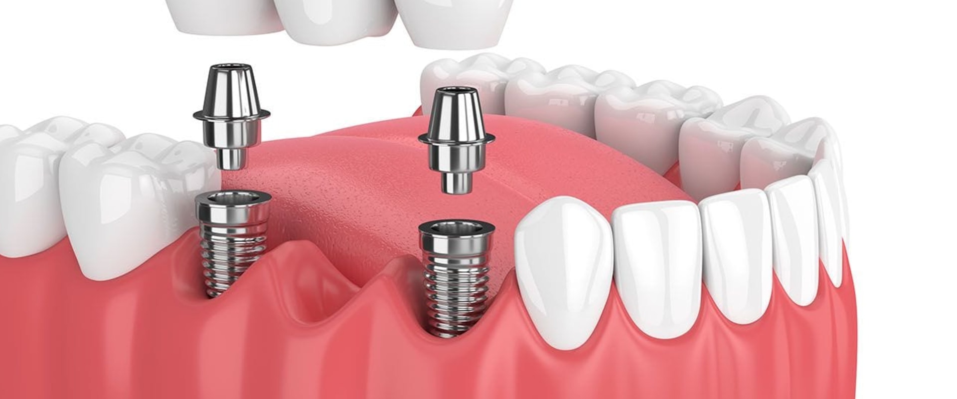 What are the 3 types of dental implants?