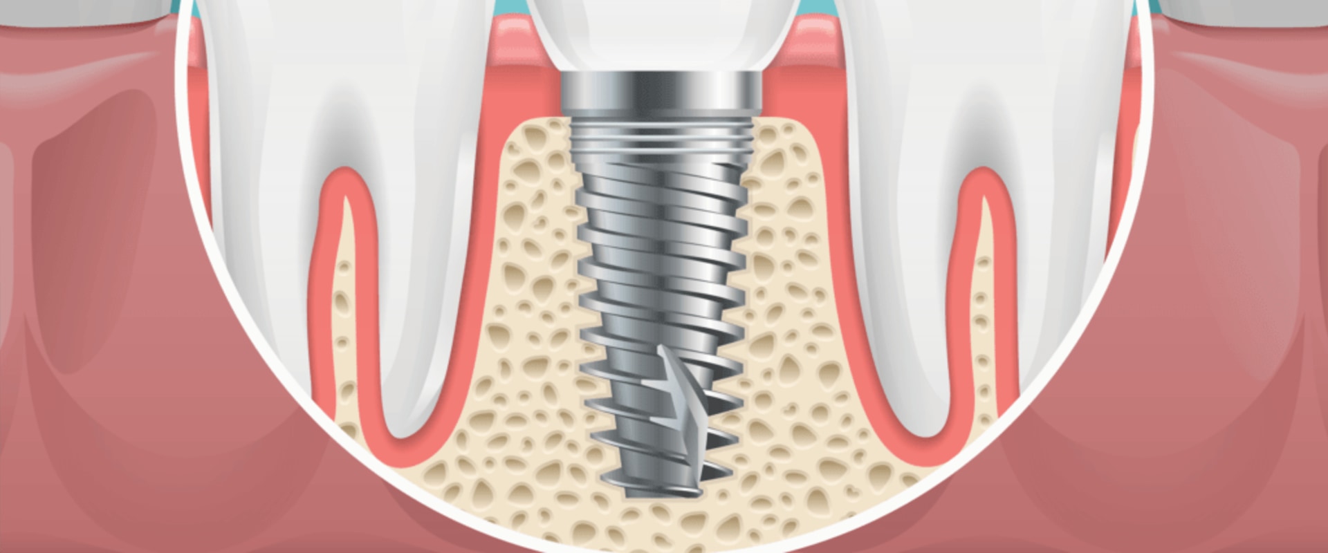 Which oral site has the highest implant failure rate?