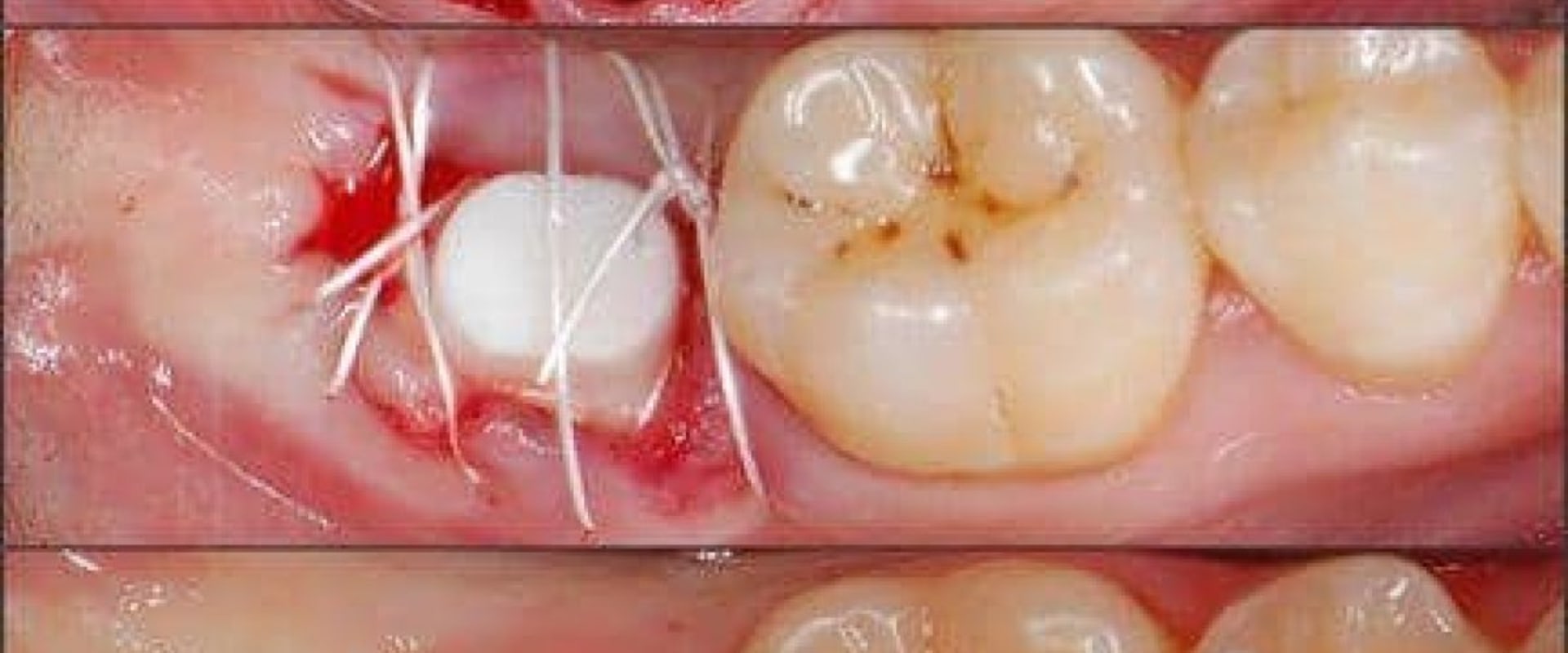 How long is your mouth sore after a dental implant?
