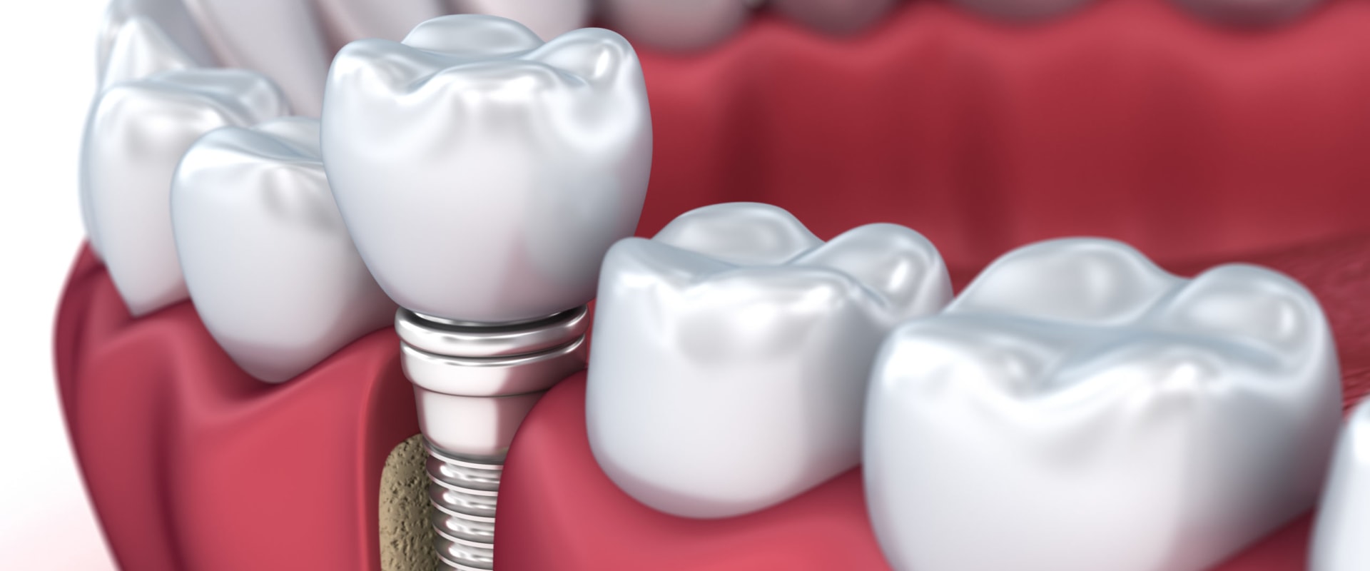 Are implants more painful than root canals?