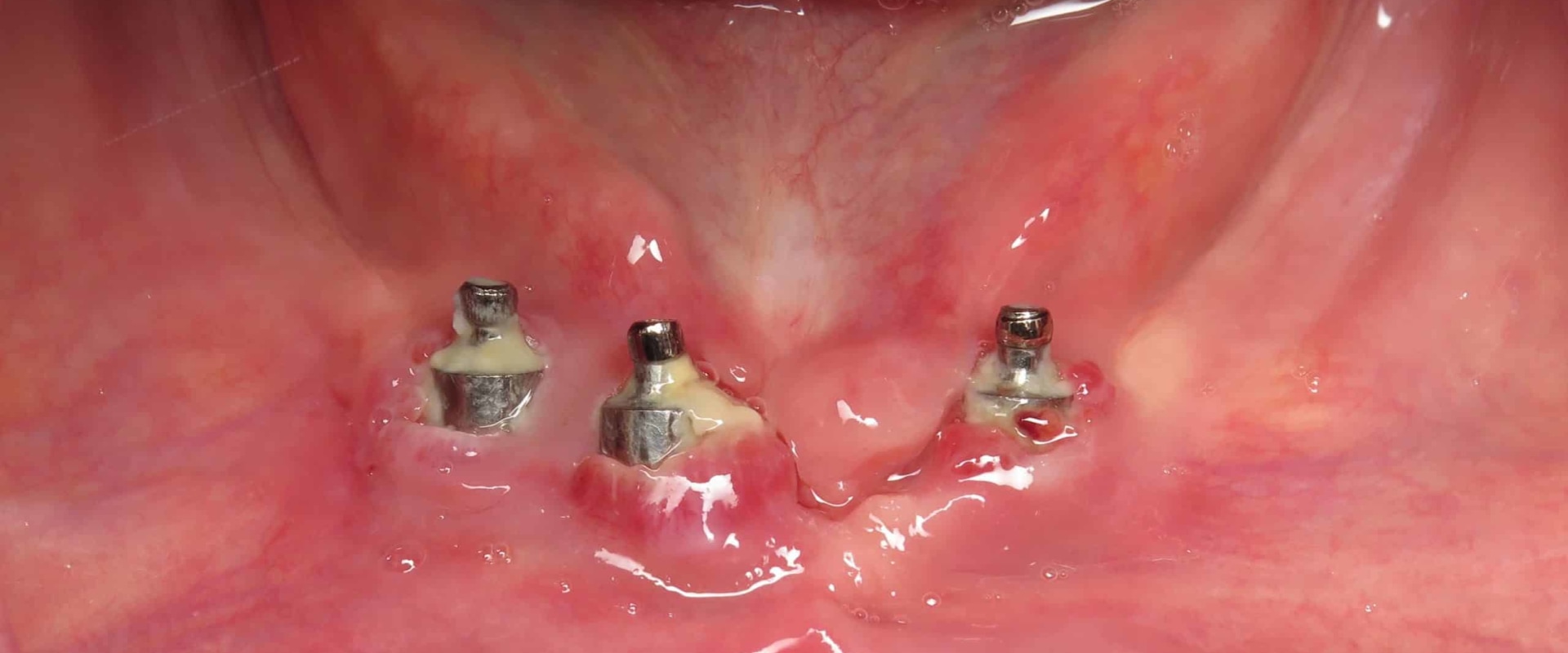 How can you tell if a dental implant is going bad?