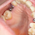 Is it painful to have an implant put in?