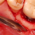 Can a dental implant become infected years later?