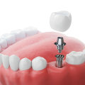 Assessing Bone Density and Gum Health: A Comprehensive Guide to Understanding Dental Implants
