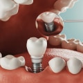 When do implants stop hurting?