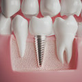 What is the average age to get dental implants?