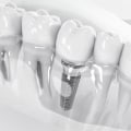 What is the most common complication of dental implants?