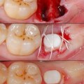 How long will a dental implant be sore?